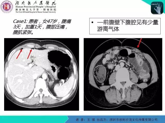 【PPT】急诊放射影像检查新变化——胸腹篇