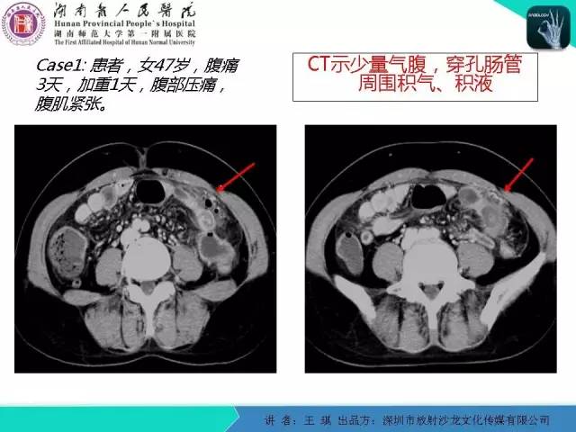 【PPT】急诊放射影像检查新变化——胸腹篇