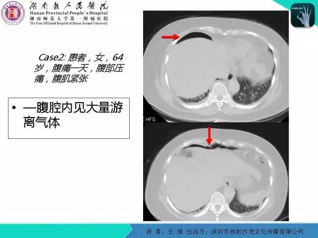 【PPT】急诊放射影像检查新变化——胸腹篇