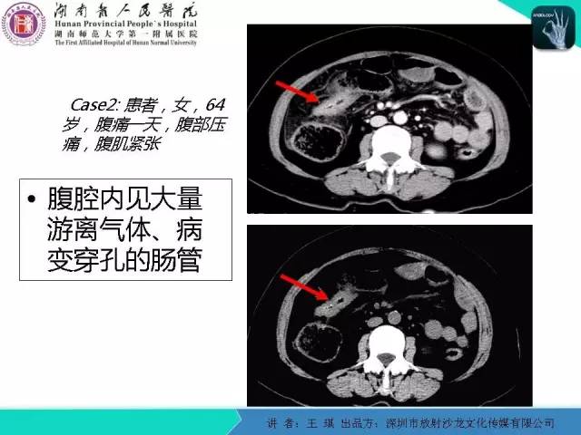 【PPT】急诊放射影像检查新变化——胸腹篇