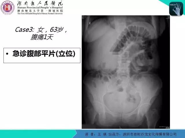 【PPT】急诊放射影像检查新变化——胸腹篇