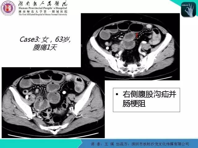 【PPT】急诊放射影像检查新变化——胸腹篇