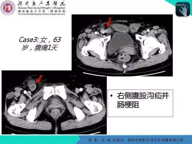 【PPT】急诊放射影像检查新变化——胸腹篇
