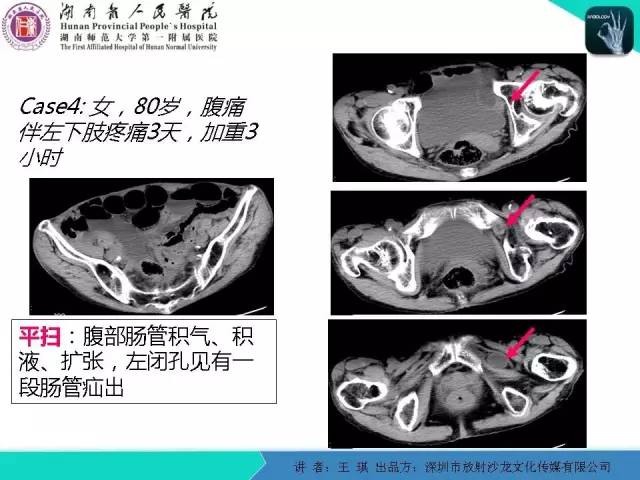 【PPT】急诊放射影像检查新变化——胸腹篇