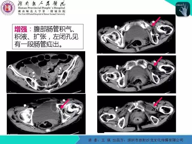 【PPT】急诊放射影像检查新变化——胸腹篇