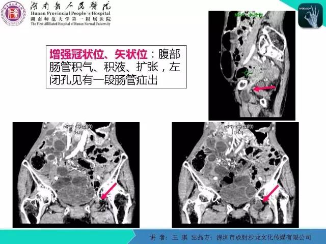 【PPT】急诊放射影像检查新变化——胸腹篇