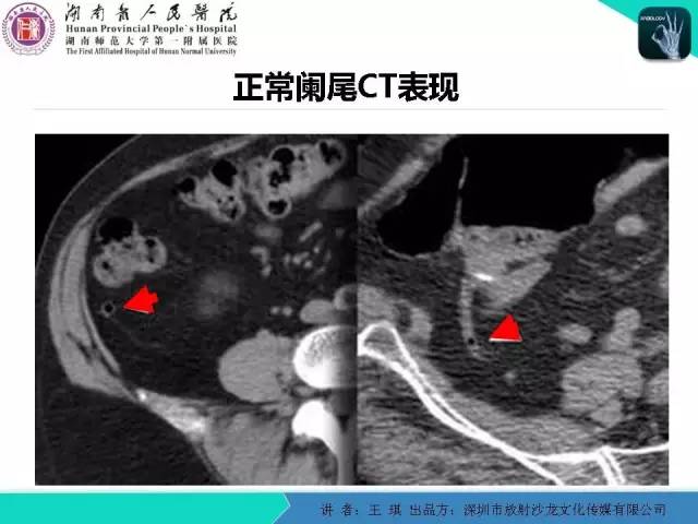 【PPT】急诊放射影像检查新变化——胸腹篇