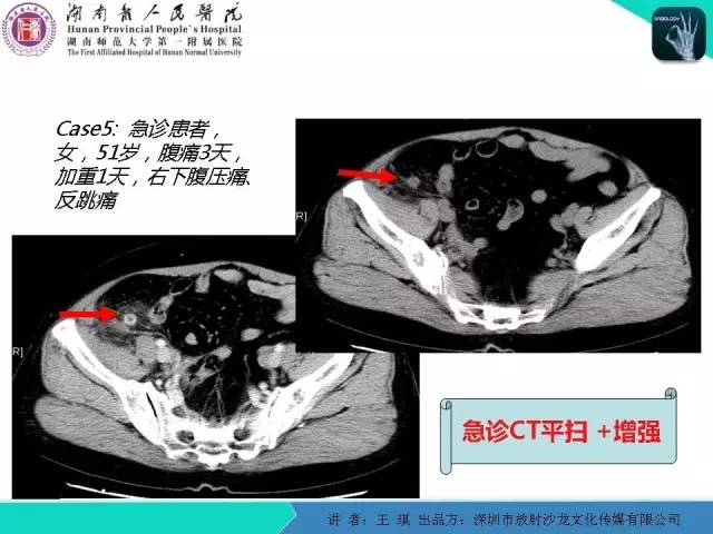 【PPT】急诊放射影像检查新变化——胸腹篇