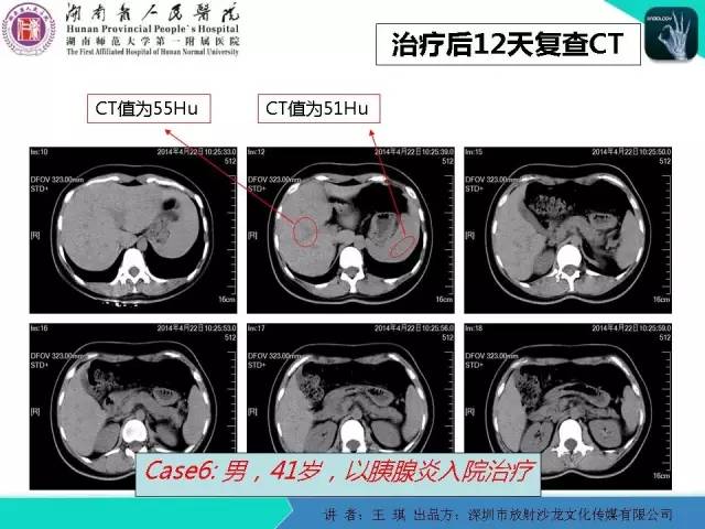 【PPT】急诊放射影像检查新变化——胸腹篇