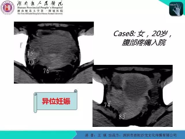 【PPT】急诊放射影像检查新变化——胸腹篇