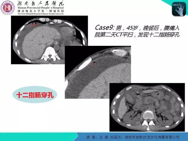 【PPT】急诊放射影像检查新变化——胸腹篇