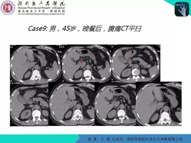 【PPT】急诊放射影像检查新变化——胸腹篇