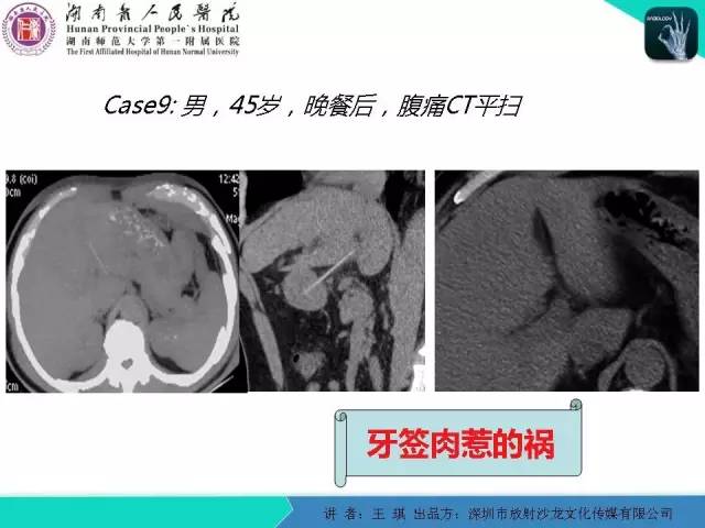 【PPT】急诊放射影像检查新变化——胸腹篇