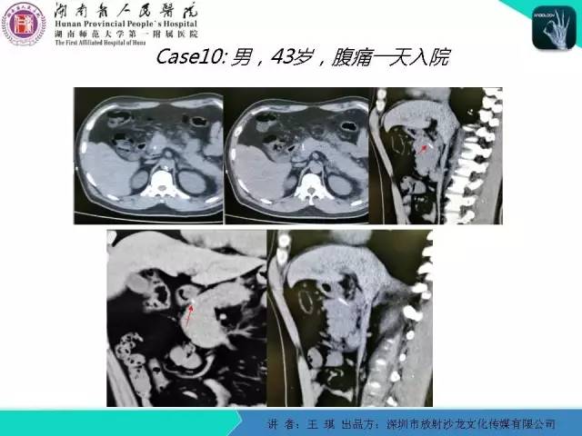 【PPT】急诊放射影像检查新变化——胸腹篇