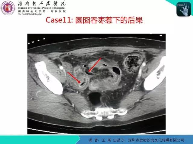 【PPT】急诊放射影像检查新变化——胸腹篇