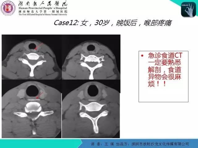 【PPT】急诊放射影像检查新变化——胸腹篇