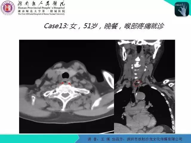 【PPT】急诊放射影像检查新变化——胸腹篇