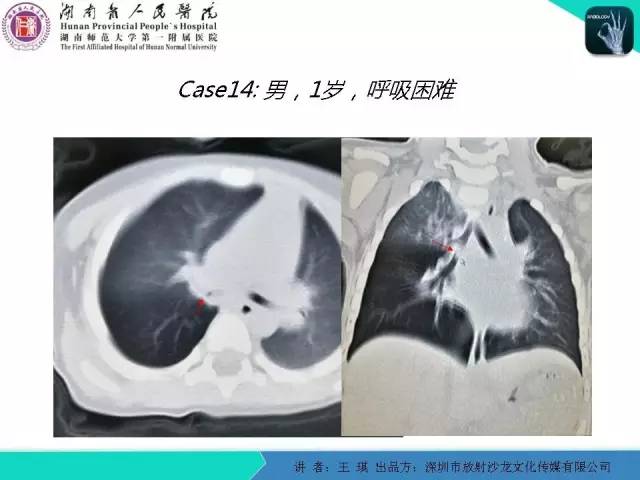 【PPT】急诊放射影像检查新变化——胸腹篇