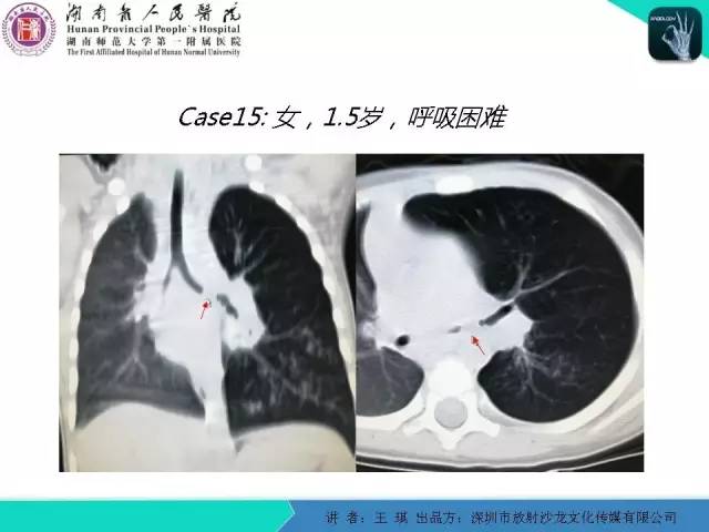 【PPT】急诊放射影像检查新变化——胸腹篇