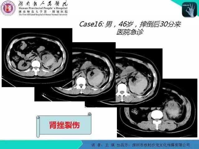 【PPT】急诊放射影像检查新变化——胸腹篇