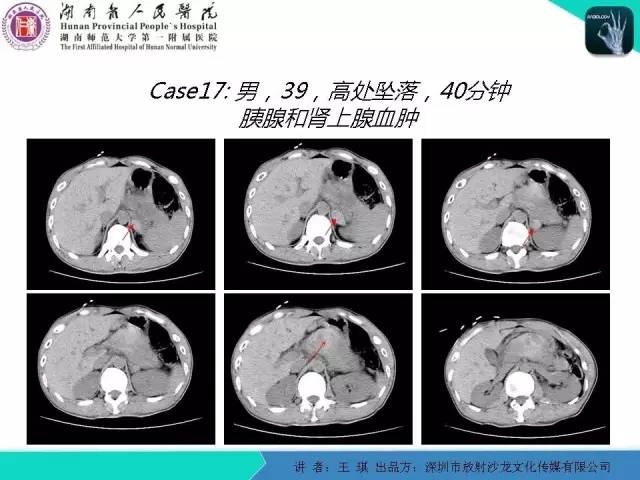 【PPT】急诊放射影像检查新变化——胸腹篇