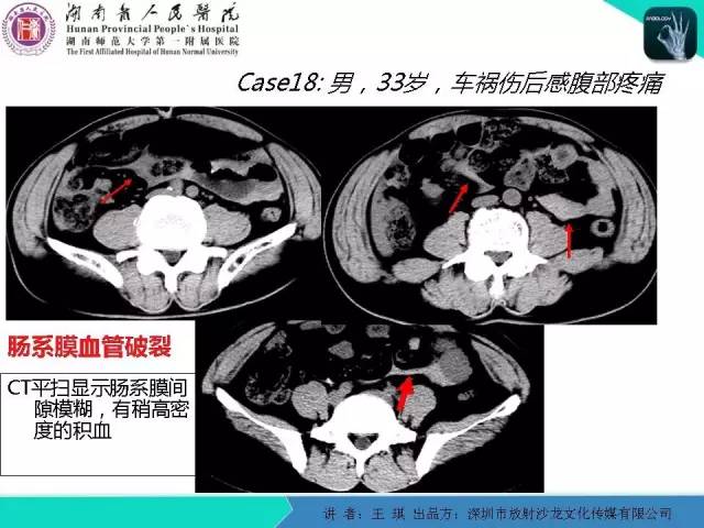 【PPT】急诊放射影像检查新变化——胸腹篇
