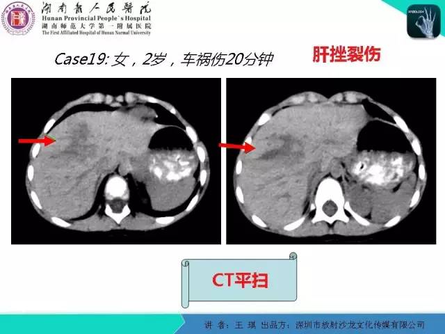 【PPT】急诊放射影像检查新变化——胸腹篇