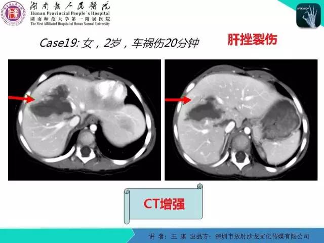 【PPT】急诊放射影像检查新变化——胸腹篇