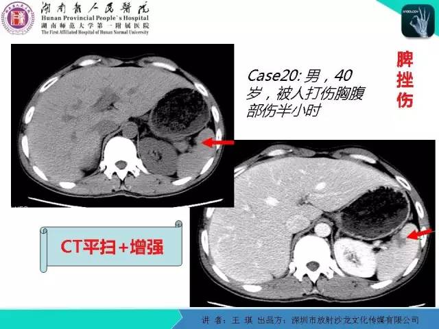 【PPT】急诊放射影像检查新变化——胸腹篇