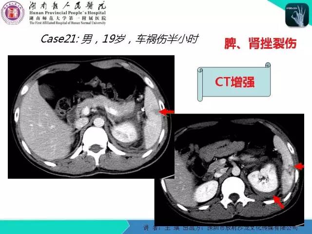 【PPT】急诊放射影像检查新变化——胸腹篇