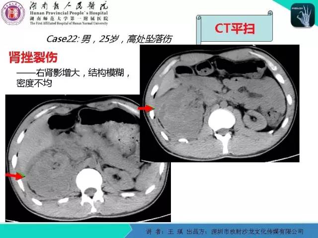 【PPT】急诊放射影像检查新变化——胸腹篇