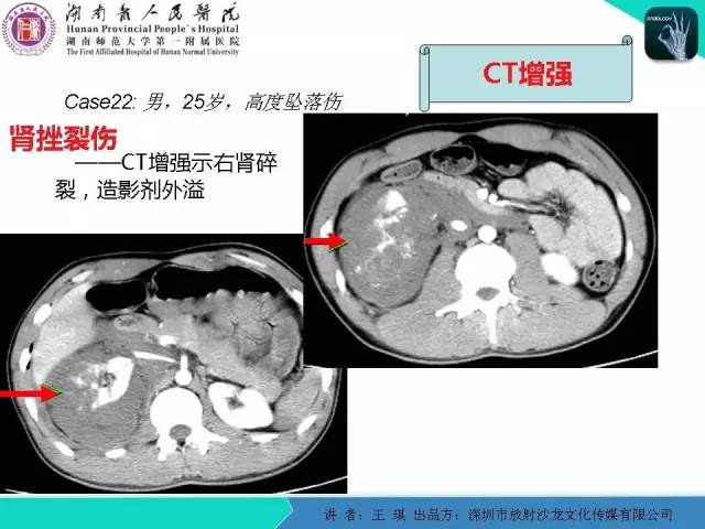 【PPT】急诊放射影像检查新变化——胸腹篇