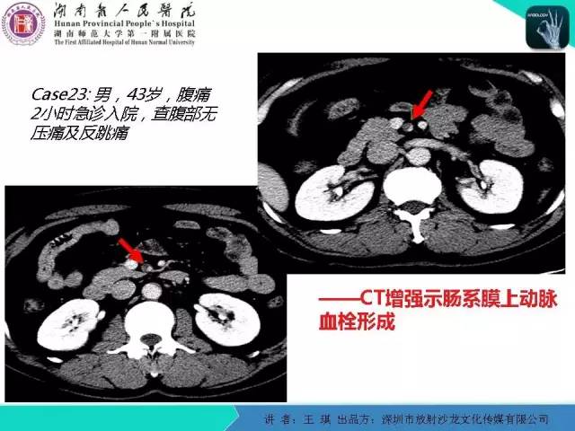【PPT】急诊放射影像检查新变化——胸腹篇