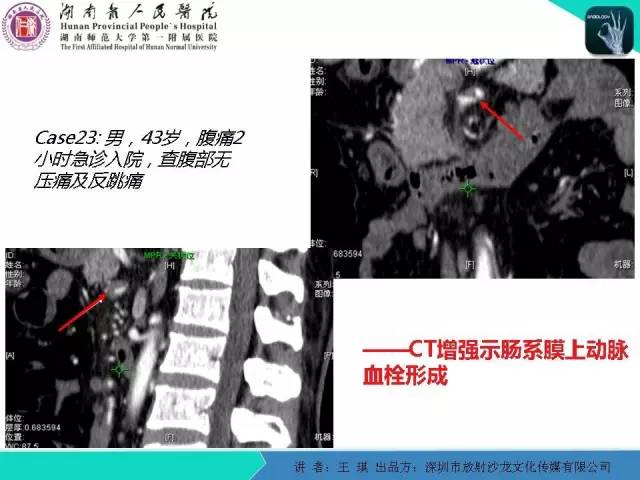 【PPT】急诊放射影像检查新变化——胸腹篇