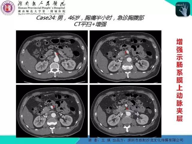 【PPT】急诊放射影像检查新变化——胸腹篇