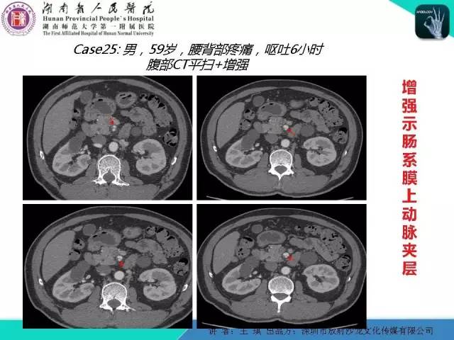【PPT】急诊放射影像检查新变化——胸腹篇