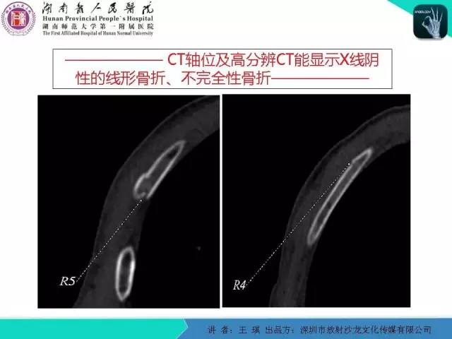 【PPT】急诊放射影像检查新变化——胸腹篇