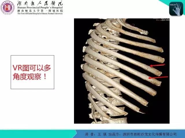 【PPT】急诊放射影像检查新变化——胸腹篇