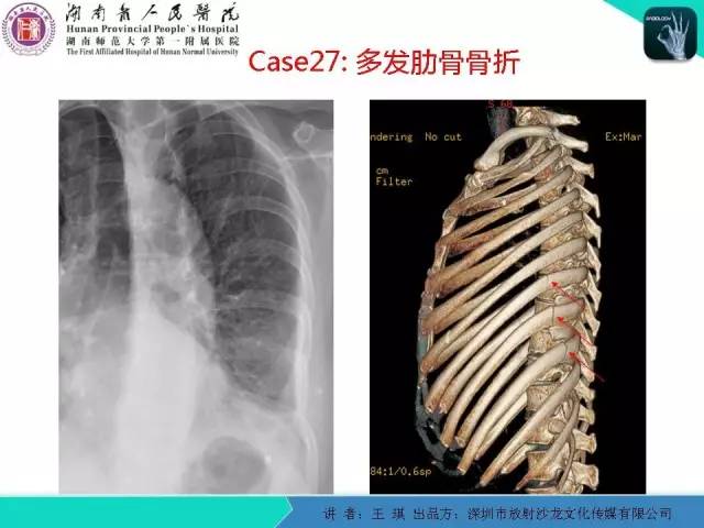 【PPT】急诊放射影像检查新变化——胸腹篇