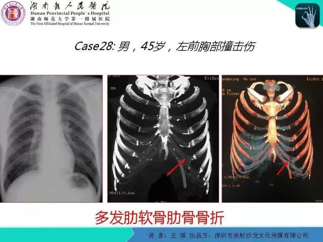 【PPT】急诊放射影像检查新变化——胸腹篇