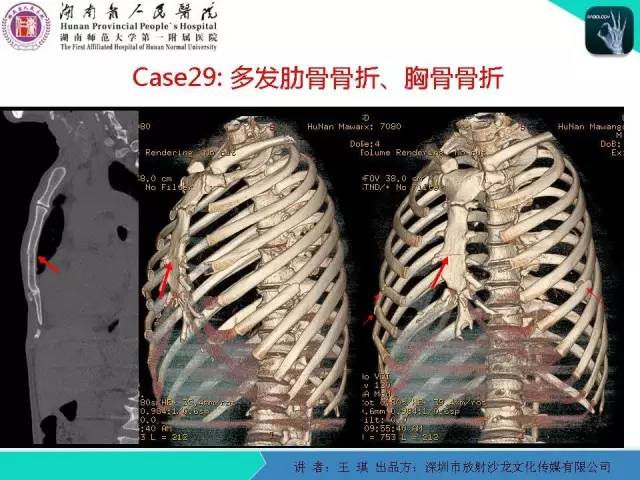 【PPT】急诊放射影像检查新变化——胸腹篇