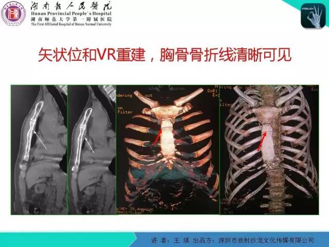 【PPT】急诊放射影像检查新变化——胸腹篇