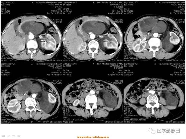 【病例】腹膜后脂肪肉瘤1例CT影像表现 【病例】腹膜后脂肪肉瘤1例CT影像表现