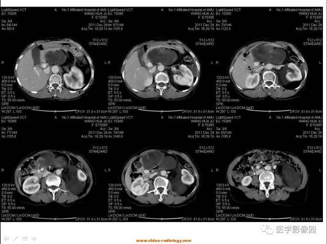 【病例】腹膜后脂肪肉瘤1例CT影像表现 【病例】腹膜后脂肪肉瘤1例CT影像表现