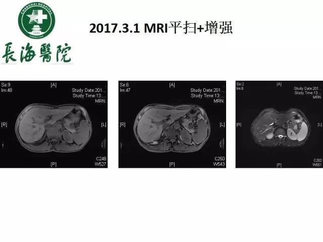 【病例】胰腺神经内分泌肿瘤1例MR
