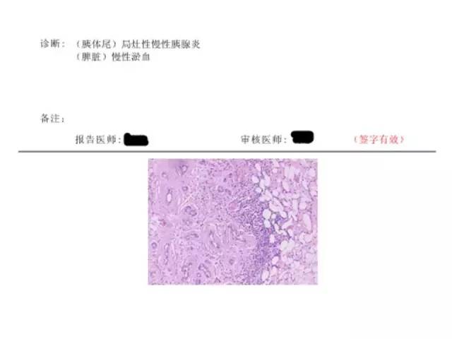 【病例】胰腺神经内分泌肿瘤1例MR