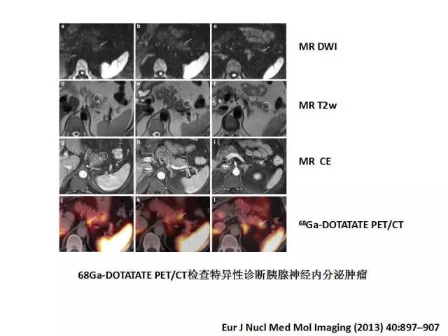 【病例】胰腺神经内分泌肿瘤1例MR