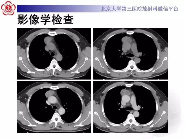 【病例】前纵隔肿瘤3例CT影像诊断