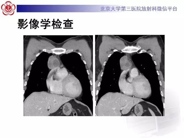 【病例】前纵隔肿瘤3例CT影像诊断