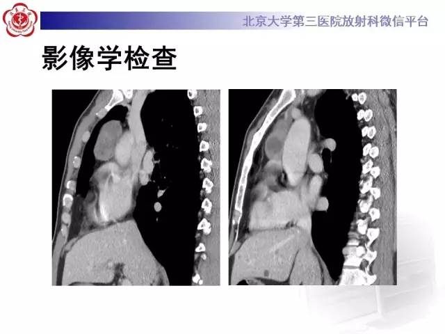 【病例】前纵隔肿瘤3例CT影像诊断